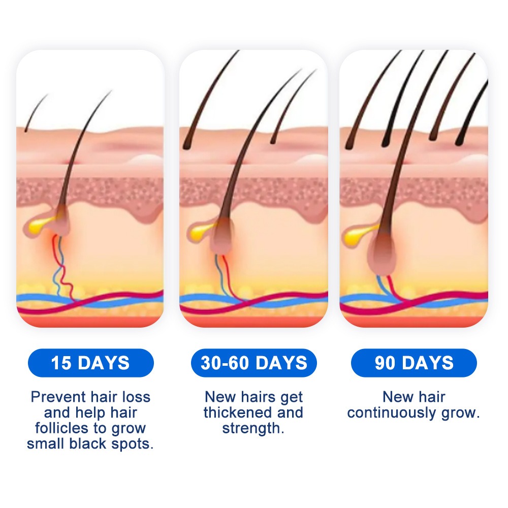 Alopecia Hair Growth Spray Sop - Hair Care Essence avaliação e preço